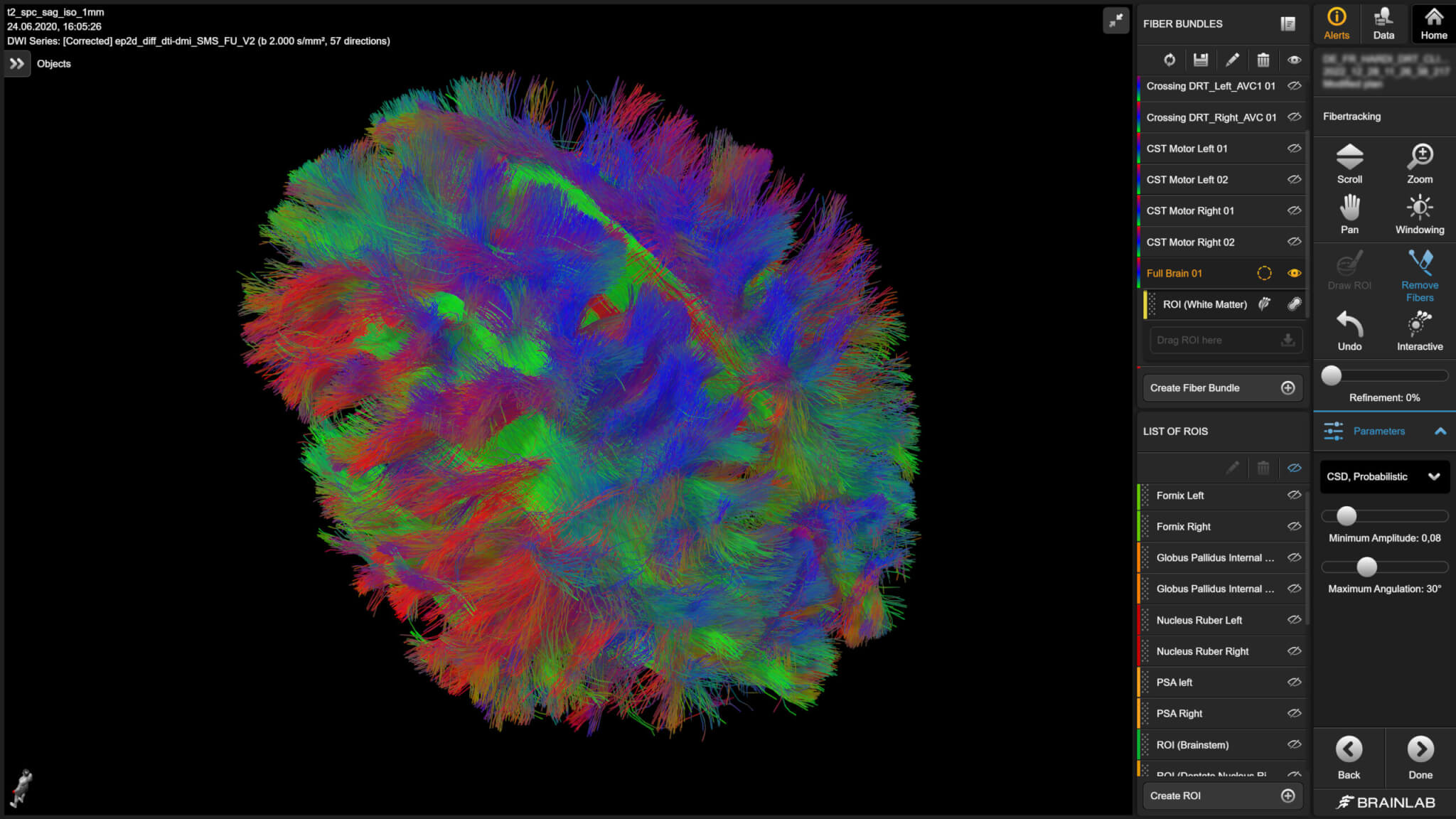 FSN Fibertracking | Brainlab